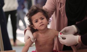 Many children in Gaza are showing signs of  severe acute malnutrition and drastic weight loss.