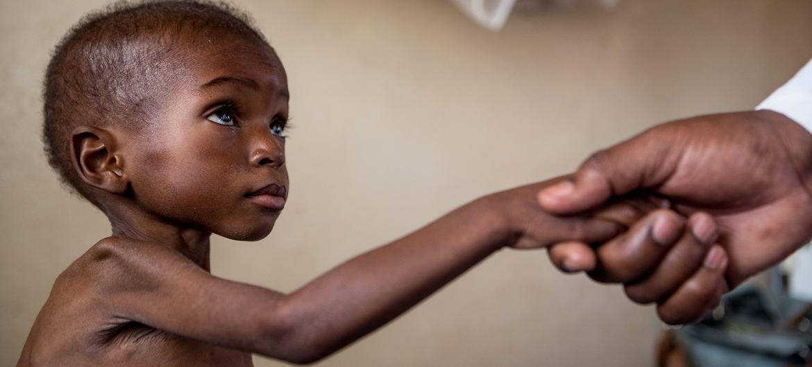 A doctor treats a toddler suffering from severe acute malnutrition and HIV at a local hospital in Katanga, DR Congo. (file)